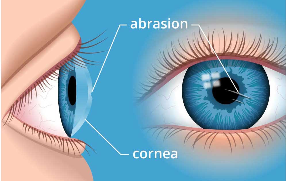What is a corneal abrasion?