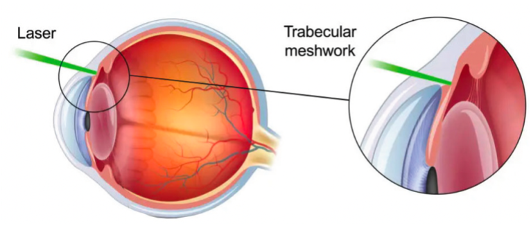 Selective laser trabeculoplasty