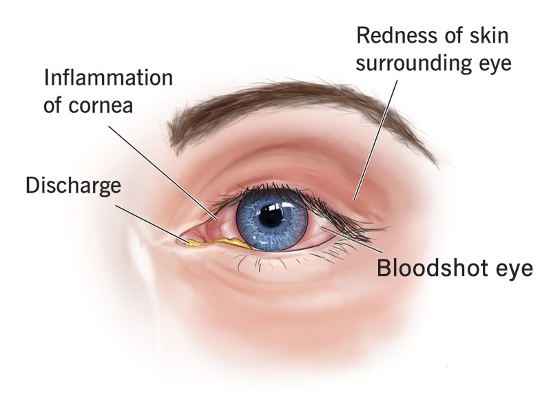 What is Cornea Ulcer?