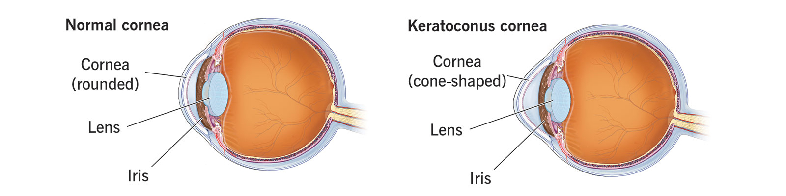 What is a keratoconus?