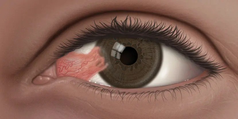 What is a What is Pterygium?